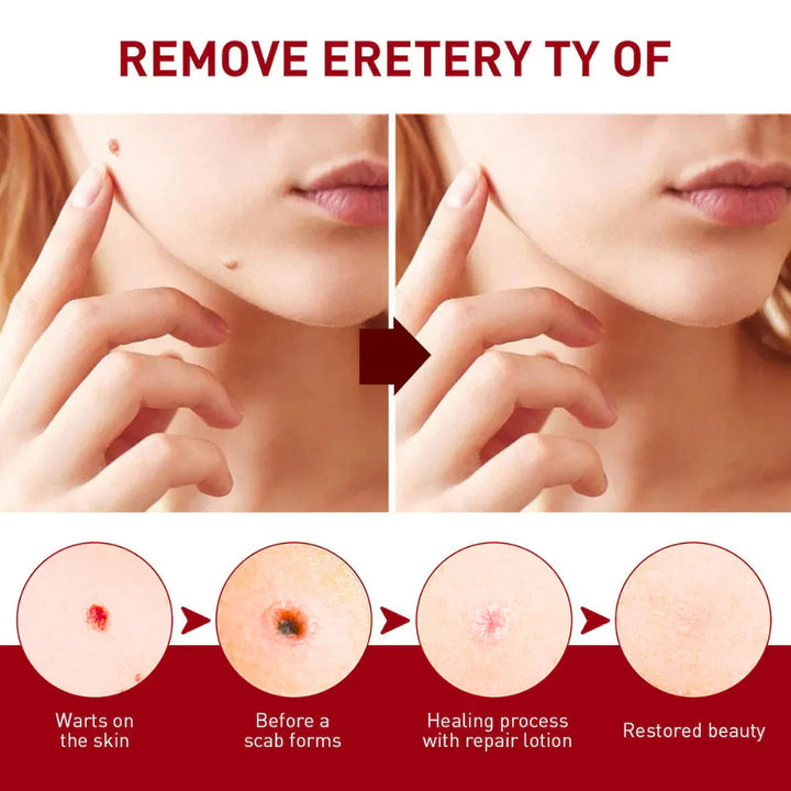 AyurvaCare™ Tags & Mole Remover